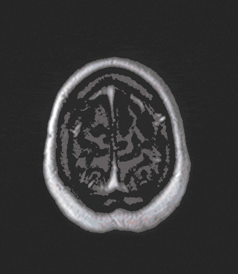 Hirntumore_Metastasen Hirntumore_Metastasen