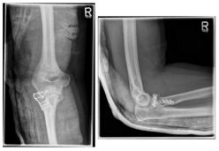 Ellenbogen3 Ellenbogen3
